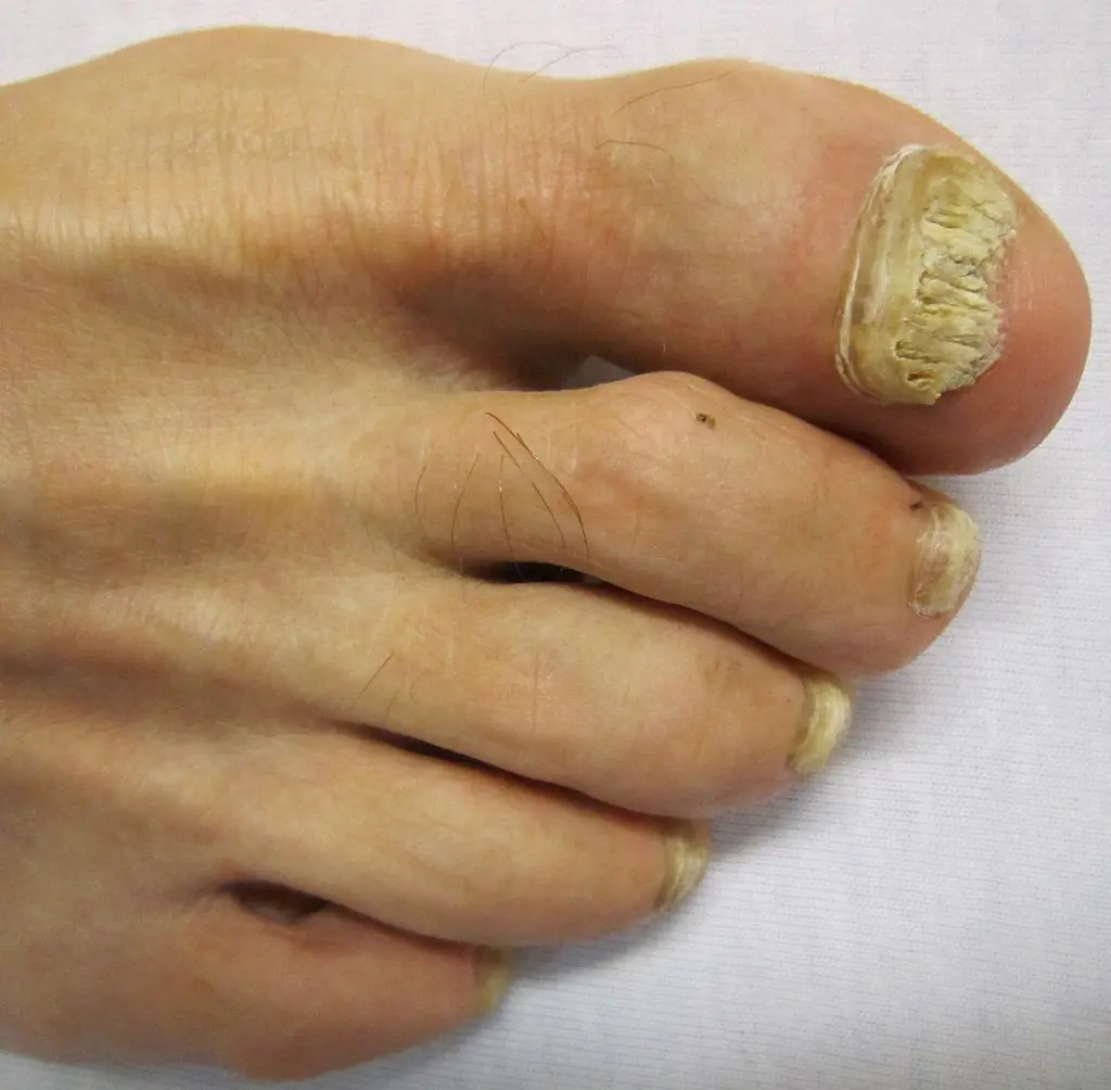 A foot with thick, yellow, crumbly toenails, worst on the big toe