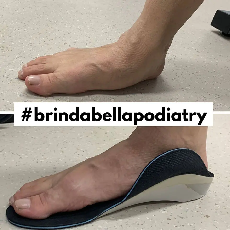 A foot with a low arch, then the same foot standing on a custom orthotic insole
