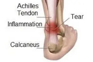 Diagram of the back of the ankle with the Achilles tendon, calcaneus, inflammation and a tear labelled