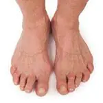 An older person's bare feet with bent, crooked toes