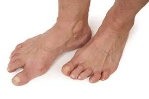 An older person's bare feet with bent, crooked toes