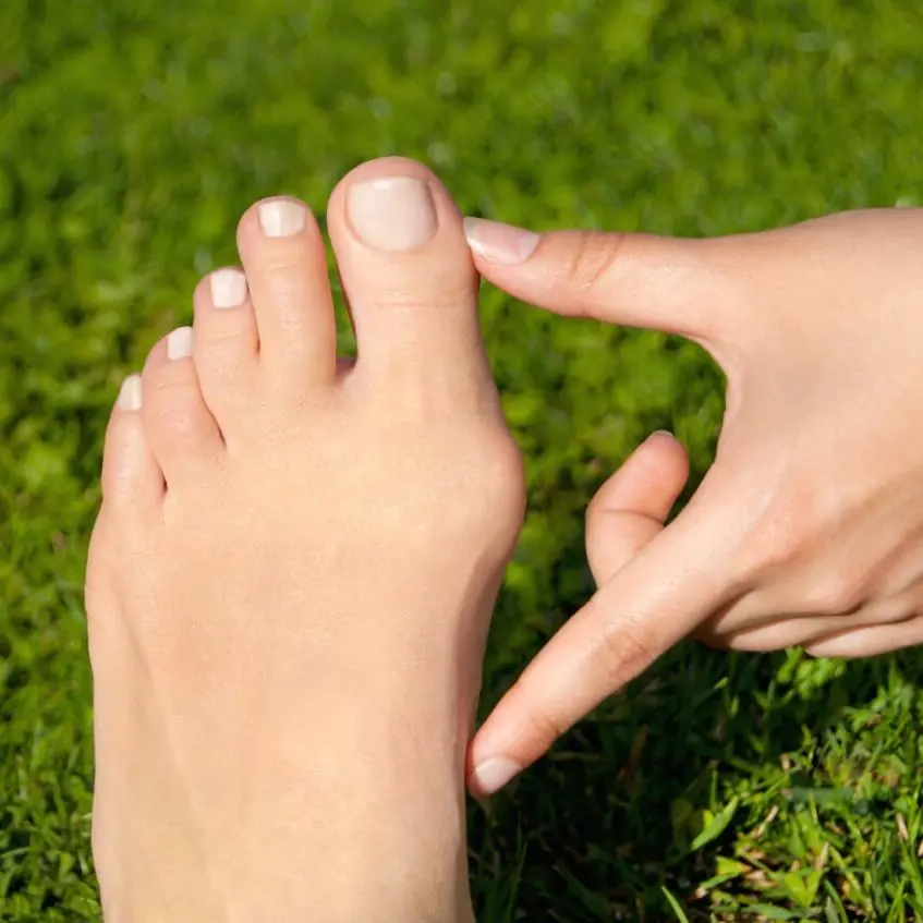 A hand points to a bunion at the base of the big toe on a bare foot