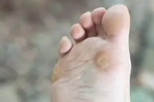 The sole of a foot with a hard yellow corn under the ball of the foot