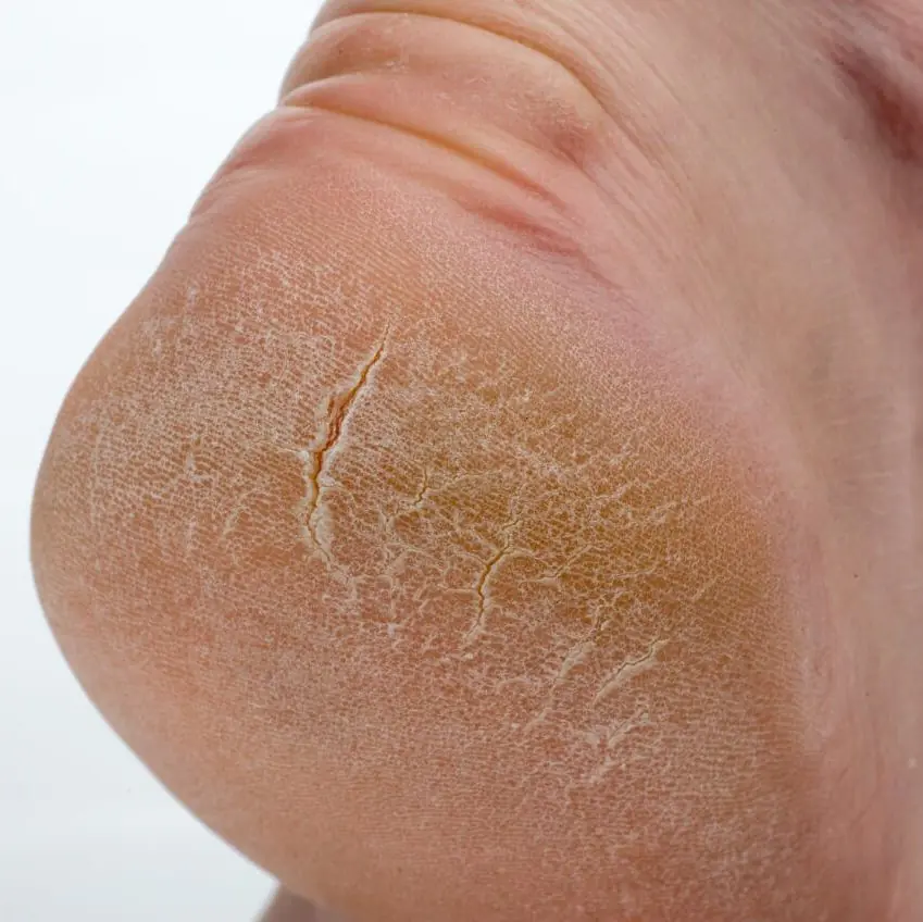 Cracked Heel