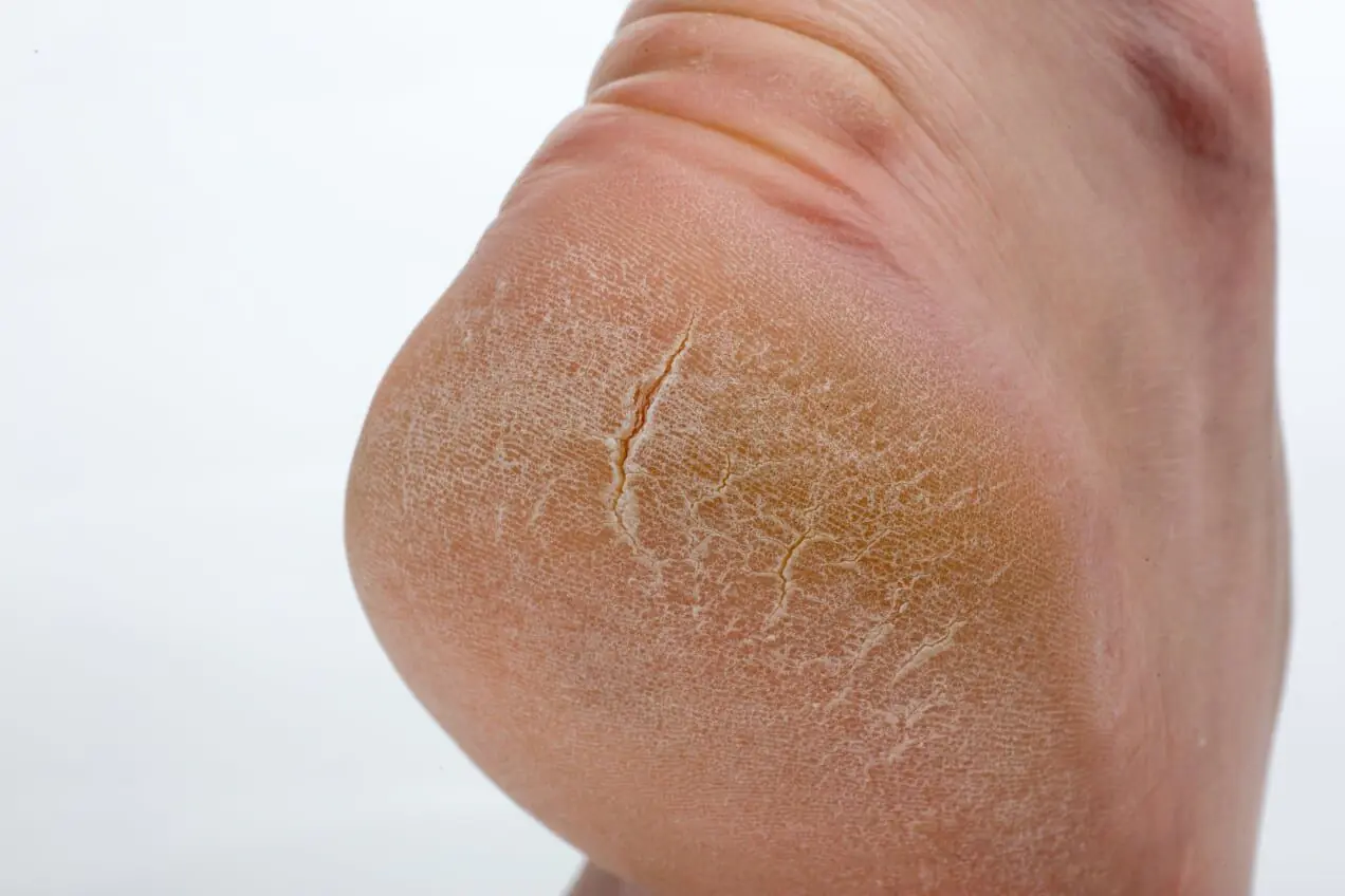 A dry heel with deep cracks in the skin