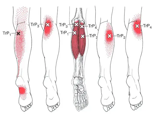Diagram of the calf muscles with trigger points marked and their areas of referred pain shaded red