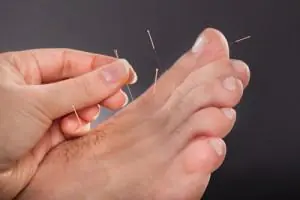 Fine needles placed in the top of a foot near the toes