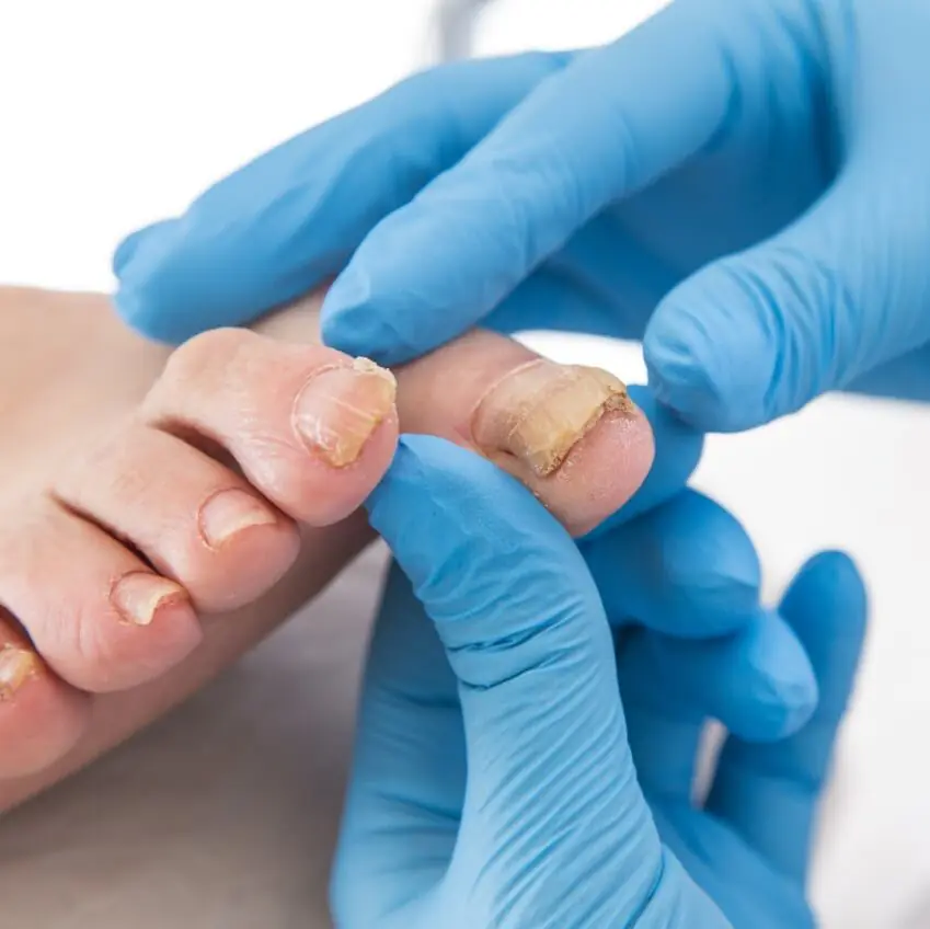 Fungal Nail