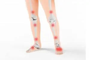Illustration of legs and their bones, with red spots at the knees, shins and ankles