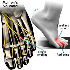 Diagram of Morton's neuroma showing nerve swelling between the toe bones and pain in the forefoot