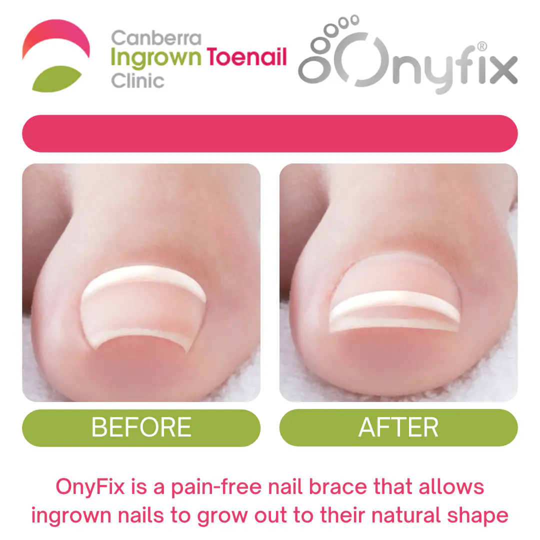 Onyfix before and after photos of a big toenail, with the Canberra Ingrown Toenail Clinic logo