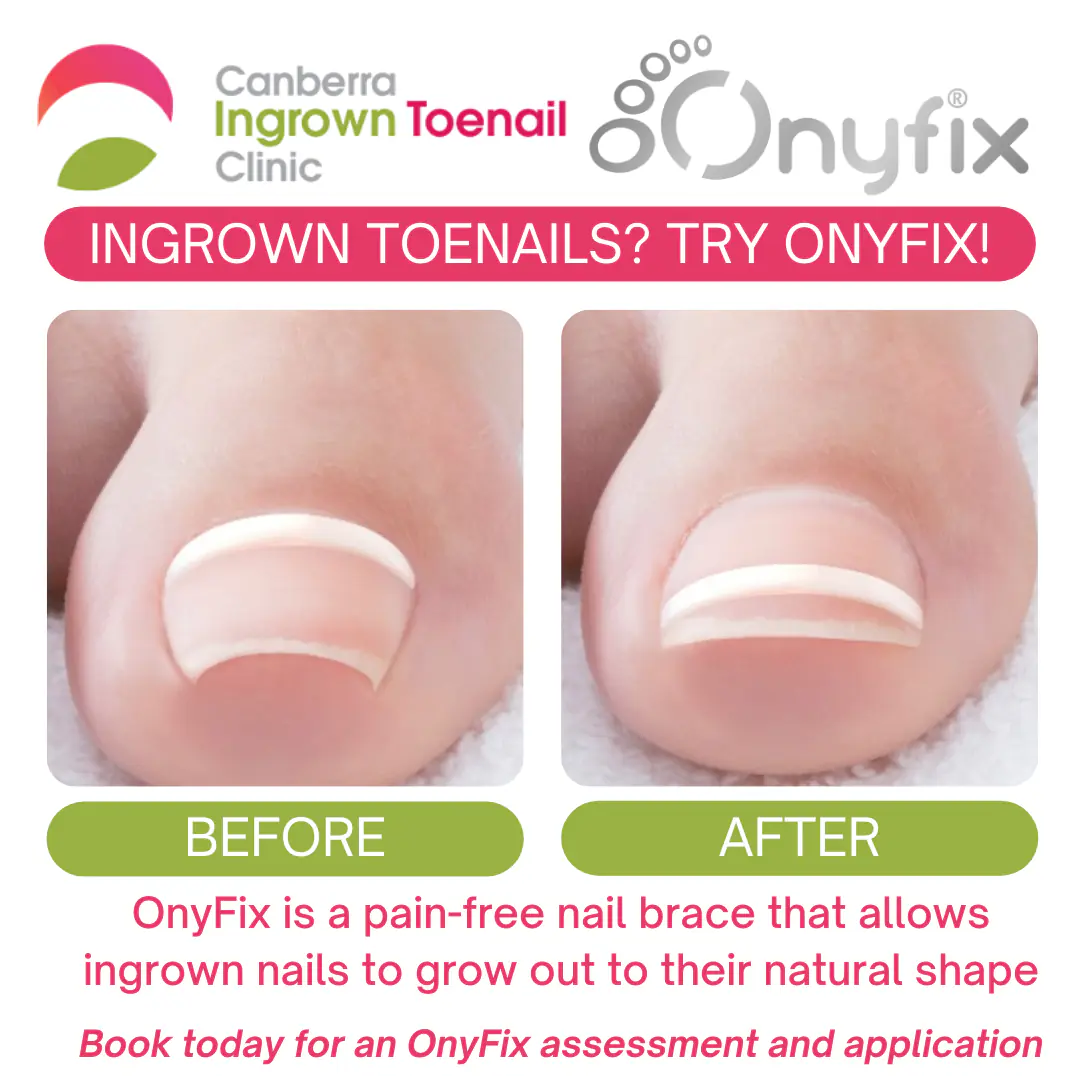 Onyfix