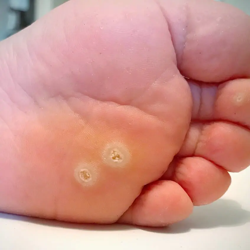 Plantar Warts