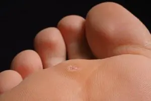 Close-up of the sole of a foot with a small wart below the toes