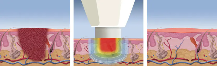 Three-panel diagram of the skin: a wart, a Swift probe applied to it, then the skin without the wart