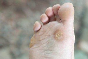 corns-and-callus