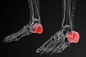 heel-bone-fracture