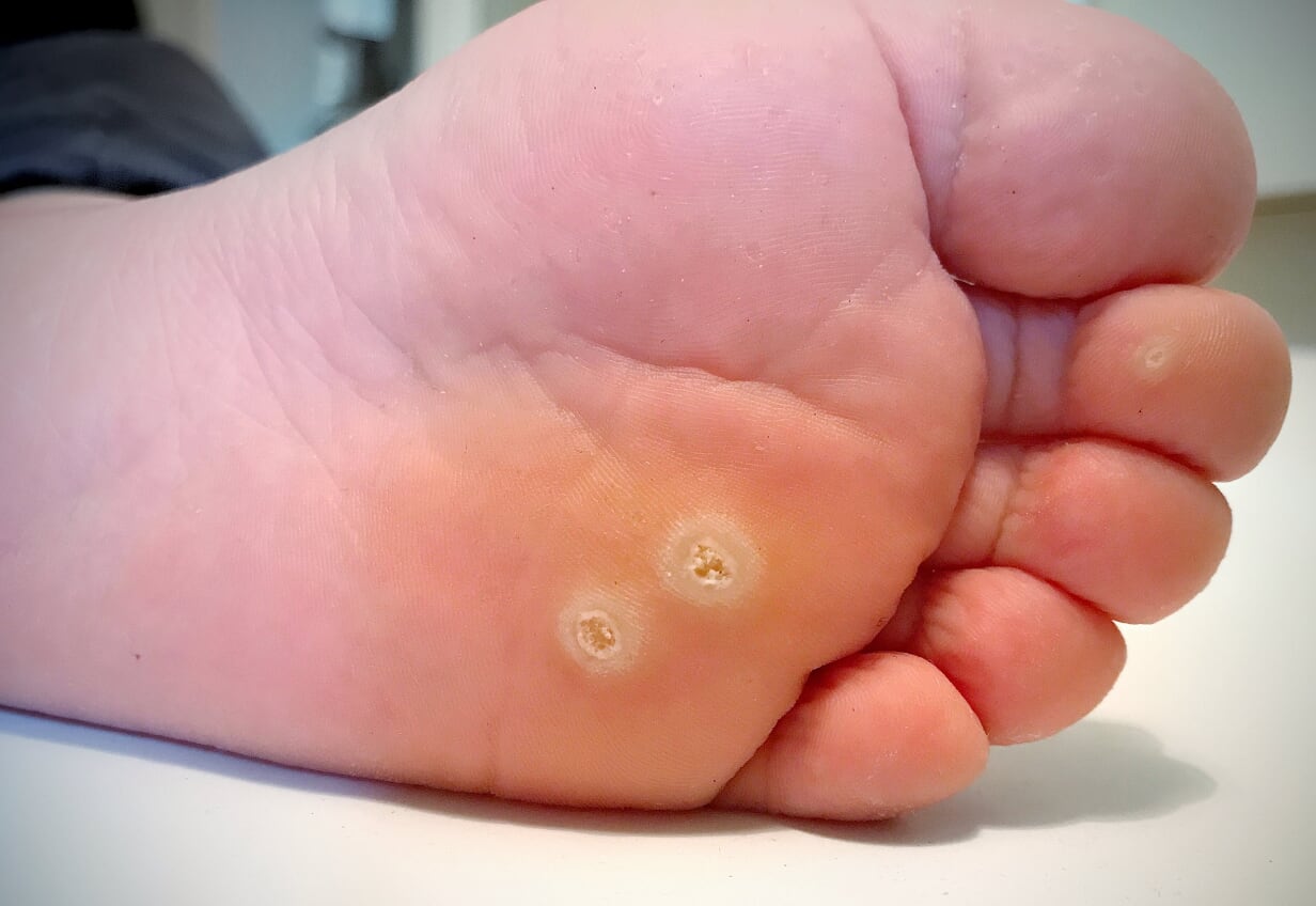 wart on foot pain la tratarea paraziților