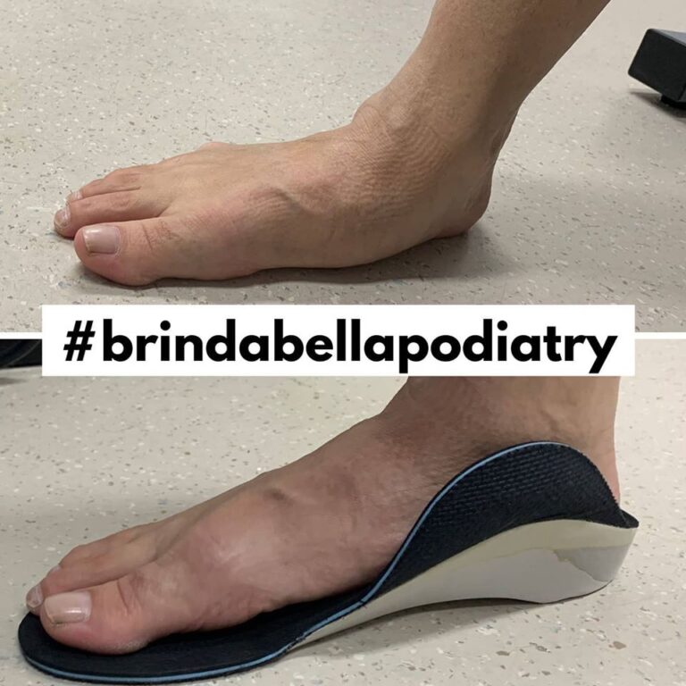 Why Do I Have Painful Fallen Arches??? Brindabella Podiatry